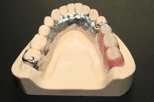 dental-laboratory-products-philippines-pfm-04