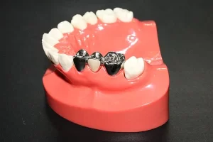 dental-laboratory-products-philippines-full-metal-crown