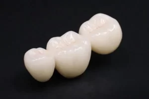 dental-laboratory-products-philippines-porcelain-fused-to-metal