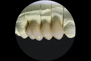 full-contour-zirconia