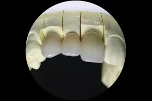 porcelain-fused-to-zirconia